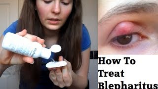 How to treat Blepharitis [upl. by Rachelle85]