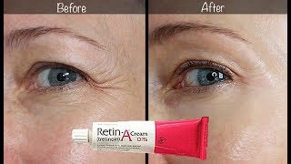 5Year RetinA Update  Before amp After for Wrinkles amp AntiAging [upl. by Adnirak]