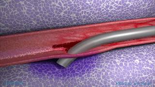 Peripheral IV Infiltration Animation [upl. by Om]