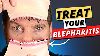 Blepharitis Top 3 Treatments For Blepharitis Removal At Home [upl. by Eidok]