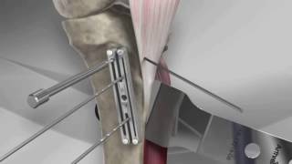 Tibial Tubercle Osteotomy [upl. by Gawen]