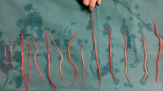 Doctors Remove 14 Roundworms From Woman [upl. by Annovahs]