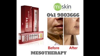 Filorga NCTF Mesotherapy [upl. by Rabush]