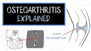 What is Osteoarthritis HealthSketch [upl. by Notnerb]