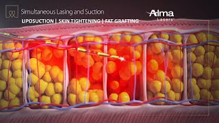 Liposuction Skin Tightening amp Fat Grafting  Lipo Life by Alma Lasers Medical Device 3D Animation [upl. by Kettie398]