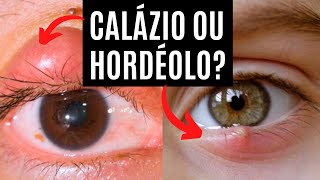 Qual a diferença entre Calázio ou Hordéolo Terçol Bolinha no olho [upl. by Hayyifas491]