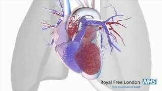 What is pulmonary hypertension [upl. by Attayek]