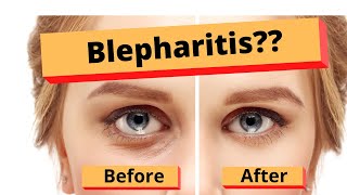 Blepharitis How to treat Blepharitis Best Home Treatment [upl. by Initsed251]