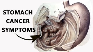 Mayo Clinic explains stomach cancer [upl. by Jareen]