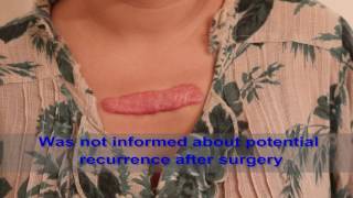 Chest Keloids  Mistakes to Avoid [upl. by Particia]