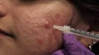 Watch amp Learn Intralesional injections [upl. by Jammal]