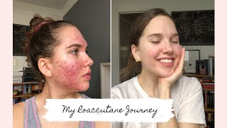 Roaccutane  My 6 Month Journey to Clear Skin [upl. by Rea]