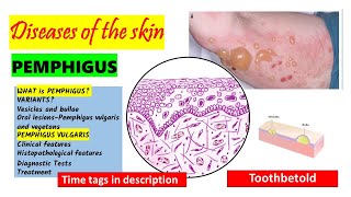 Pemphigus Vulgaris  HISTOPATHOLOGY  Immunofluorescence  Treatment  PART 22 [upl. by Ociral]