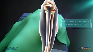 Tibial tubercle osteotomy TTO [upl. by Macy]