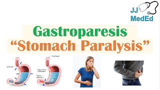 Gastroparesis Stomach Paralysis  Causes and Risk Factors Signs amp Symptoms Diagnosis Treatment [upl. by Avika]