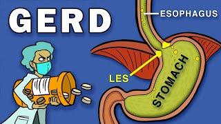 Gastroesophageal Reflux Disease GERD [upl. by Brittnee]