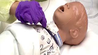 What is Tracheostomy [upl. by Oeram]