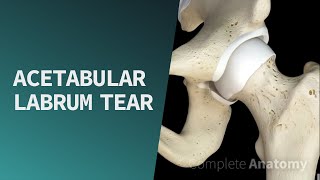 Acetabular Labrum Tear  Pathologies [upl. by Sikleb617]