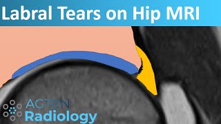 Labral Tears on Hip MRI [upl. by Ullund]