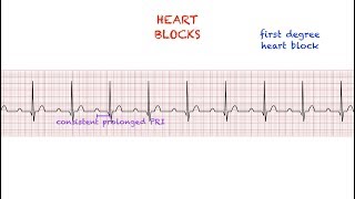 EKG like a BOSS Part 3  Abnormal Heart Rhythms [upl. by Nonad]