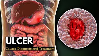 Acute Gastritis Stomach Inflammation  Causes Signs amp Symptoms Diagnosis Treatment [upl. by Kraft]