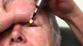 Blepharitis Treatment That Really Works Blephex Eyelid Cleaning [upl. by Maryl]