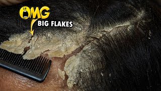 Dandruff Removal Big Flakes Satisfying 811 [upl. by Zelle]