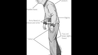 Extrapyramidal Symptoms [upl. by Asiek]