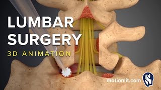 Lumbar Surgery  Laminectomy  3D Medical Animation [upl. by Ecirtaeb891]