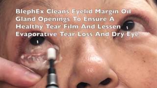 BlephEx Eyelid Treatment For Dry Eyes Blepharitis by Dr Burroughs in Colorado Springs [upl. by Attegroeg]