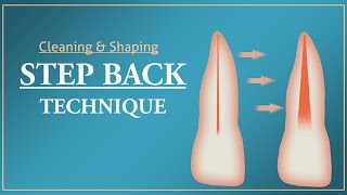 Step Back Technique  Root Canal Treatment [upl. by Doak501]