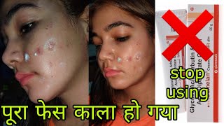 ❌STOP 🛑 USING DEMELAN CREAM  Skin Whitening Cream  Demelan Cream in Hindi  पूरा फेस काला हो गया [upl. by Saidnac483]