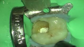 Simple Technique for PreEndodontic Restoration [upl. by Eiuqcaj]