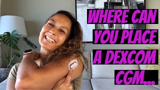 Where Can You Place a Dexcom CGM [upl. by Alric40]