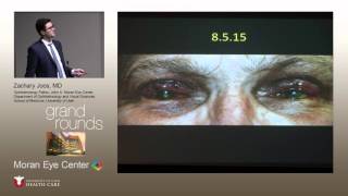 Ocular Cicatricial Pemphigoid Multidisciplinary Approach [upl. by Acinonrev891]