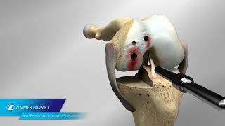 Oxford® Partial Knee Microplasty® Instrumentation Animation [upl. by Hayman]