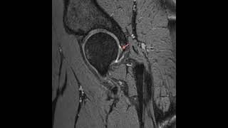 Acetabular Labrum Tear  Pathologies [upl. by Banwell]